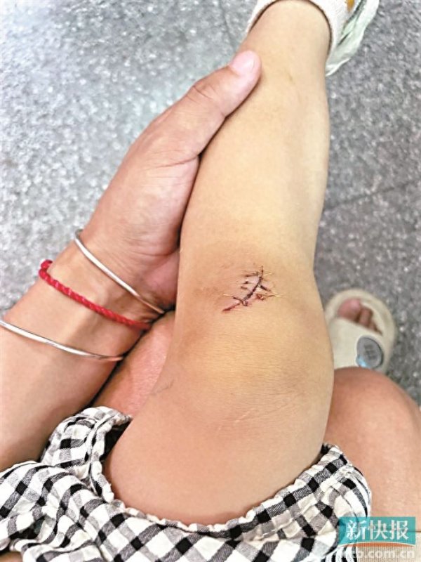 富腾优配  孩童玩耍时被商场地面裸露铁丝刮伤缝了四针